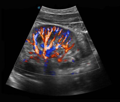 Color Doppler scan at Himalayan Diagnostics Dehradun showing real-time blood flow assessment using advanced ultrasound imaging.