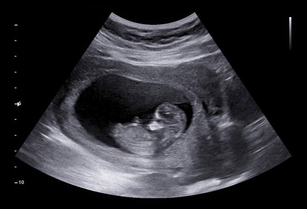 Prenatal ultrasound checkup at Himalayan Diagnostics Dehradun