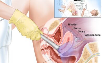 Transvaginal ultrasound for non-gynecological pelvic conditions at Himalayan Diagnostics Dehradun