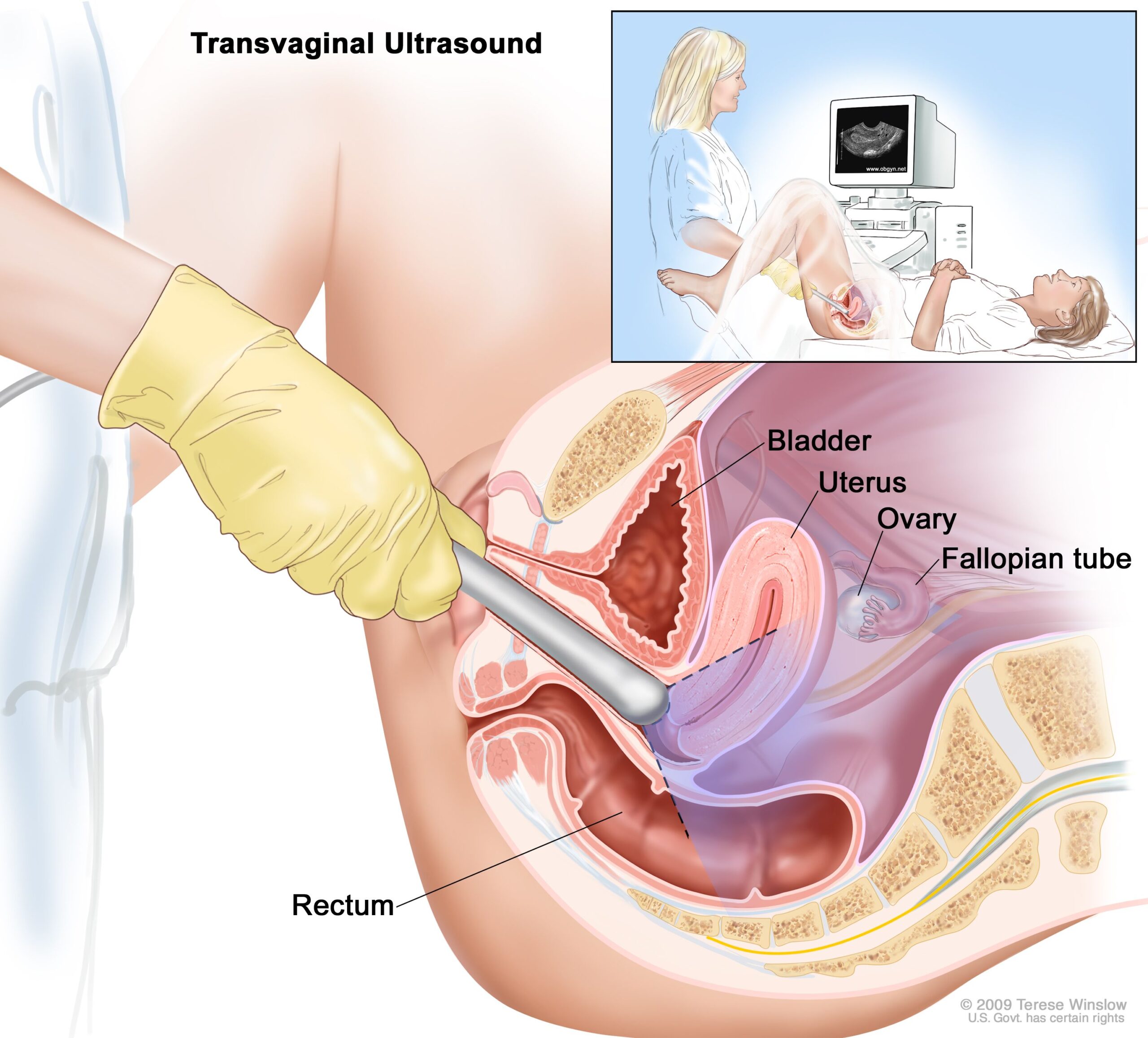 Transvaginal ultrasound for non-gynecological pelvic conditions at Himalayan Diagnostics Dehradun