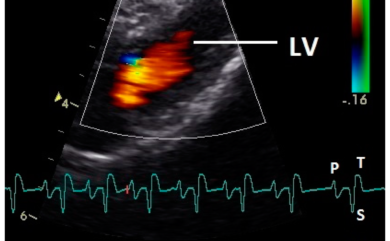 Color Doppler Ultrasound in Dehradun Uttarakhand at Himalayan Diagnostics