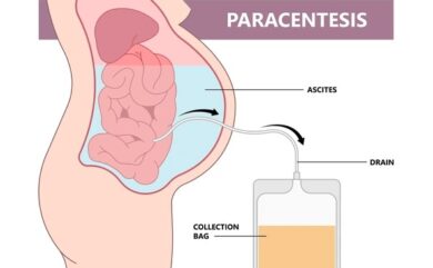 Ultrasound-guided ascitic tapping (paracentesis) procedure for safe abdominal fluid removal