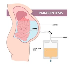 Ultrasound-guided ascitic tapping (paracentesis) procedure for safe abdominal fluid removal