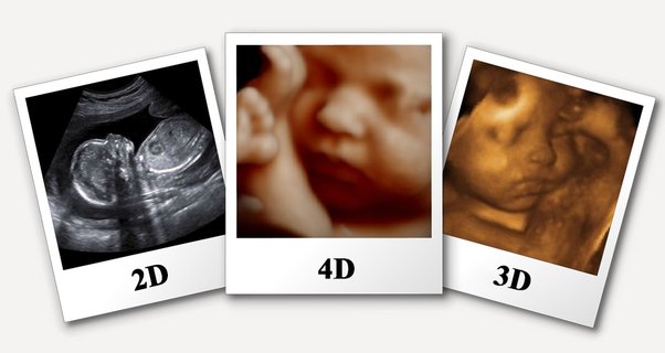 Book 3D 4D 5D ultrasound in Dehradun at Himalayan Diagnostics pregnancy scan center